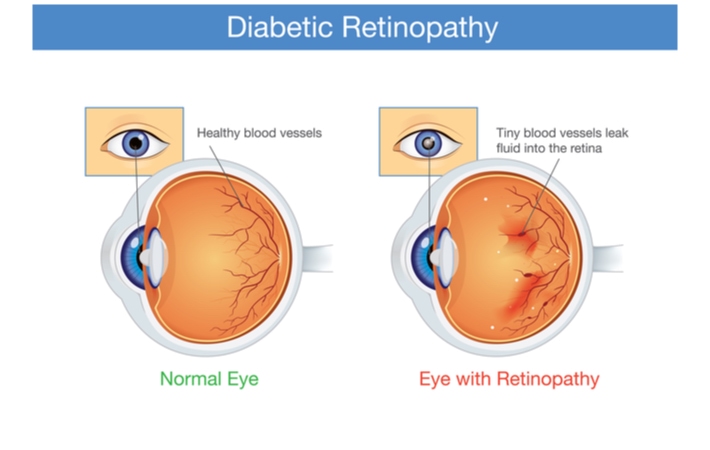 Graphical representation of two eye cross sections. The left is a normal eye showing healthy blood vessels, while the right is an eye with diabetic retinopathy showing tiny blood vessels that leak fluid into the retina to create floaters.