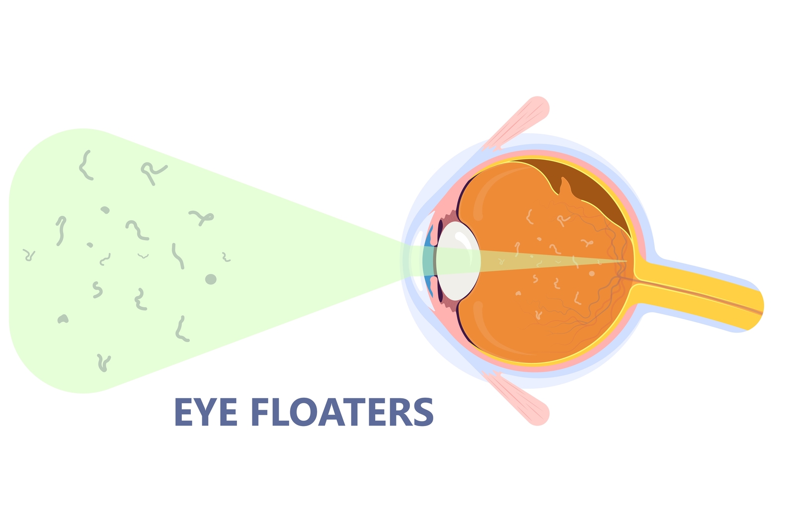 Graphical representation of eye floaters. A cross section of an eye with small floaters inside the vitreous fluid, is shown to project the floaters as what someone would see.