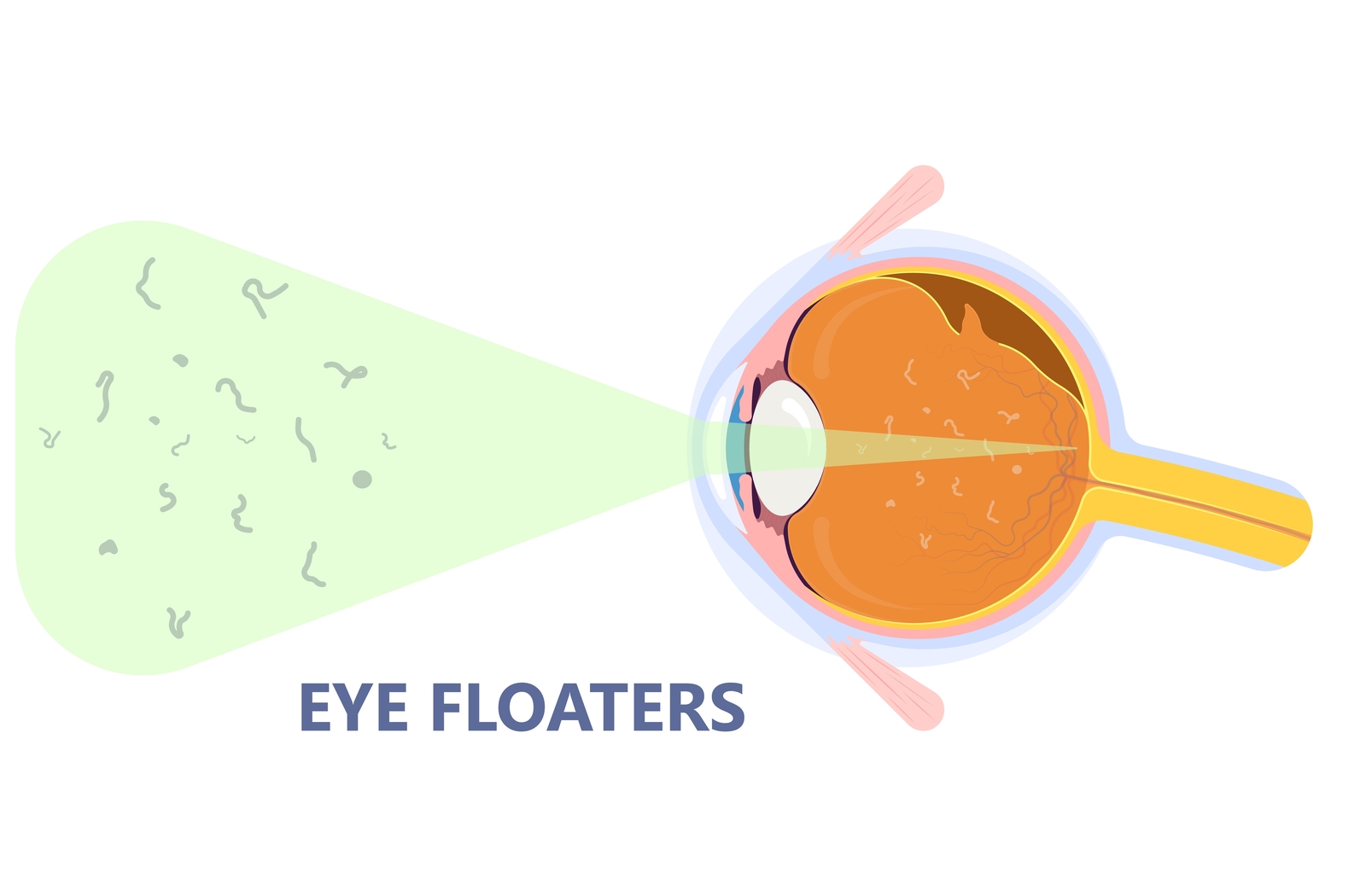 Can High Blood Sugar Cause Eye Floaters